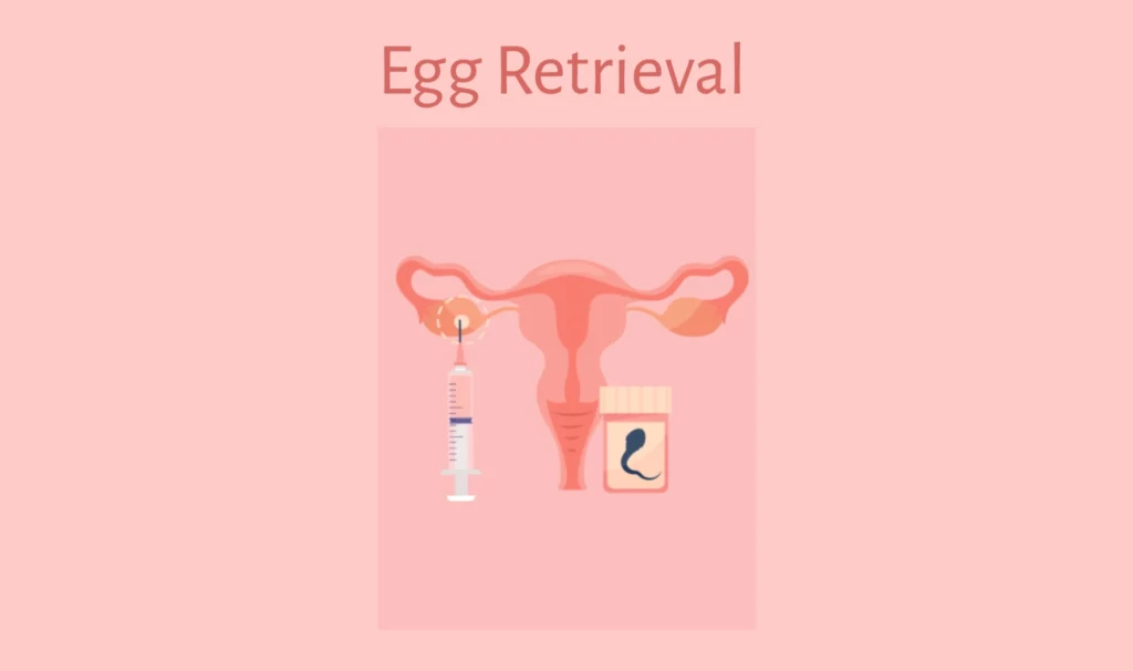 Egg Retrieval in IVF