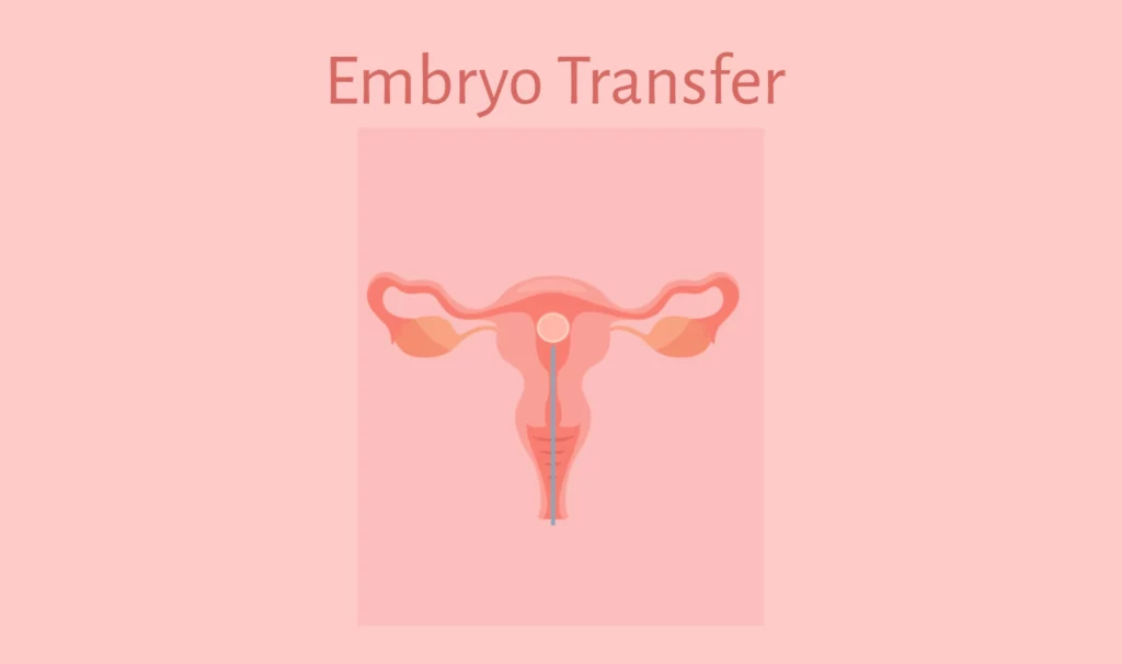 Embryo Transfer in IVF