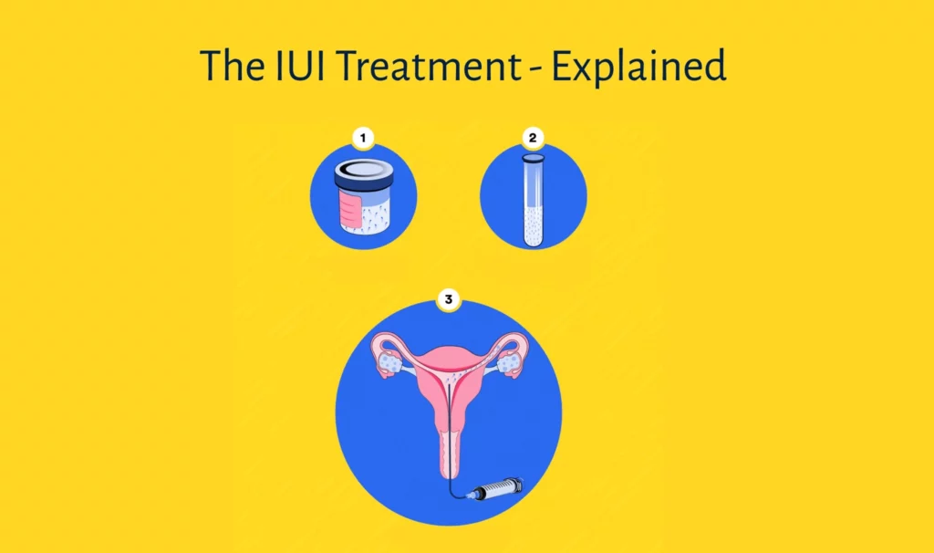 The IUI Treatment Explained