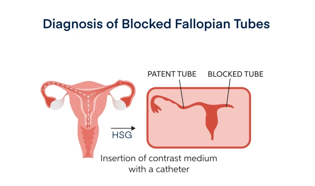 Diagnosis of Blocked Fallopian Tubes