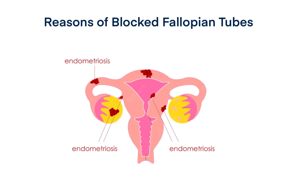 Reasons of Blocked Fallopian Tubes
