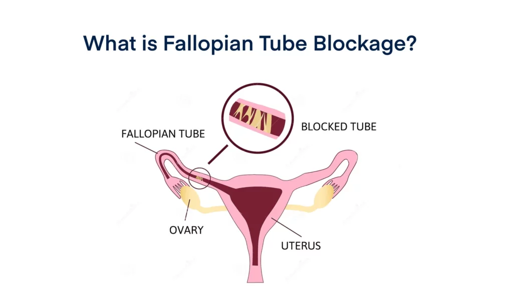 What is Fallopian Tube Blockage