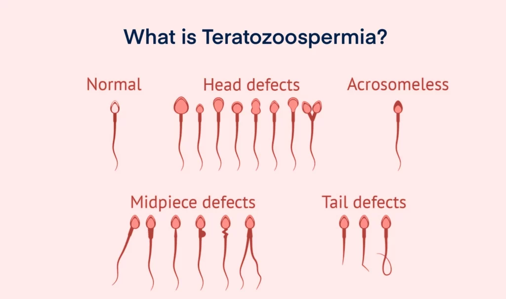 What is Teratozoospermia