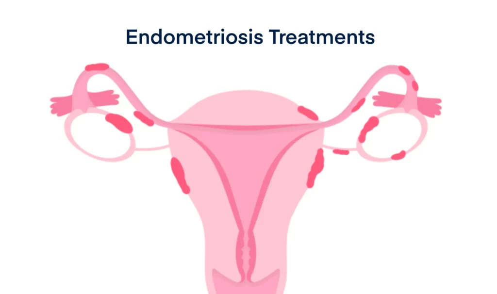 Endometriosis Treatments