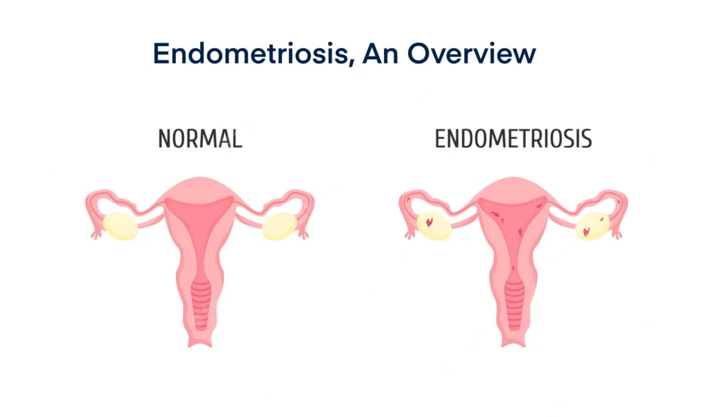 Endometriosis, an Overview