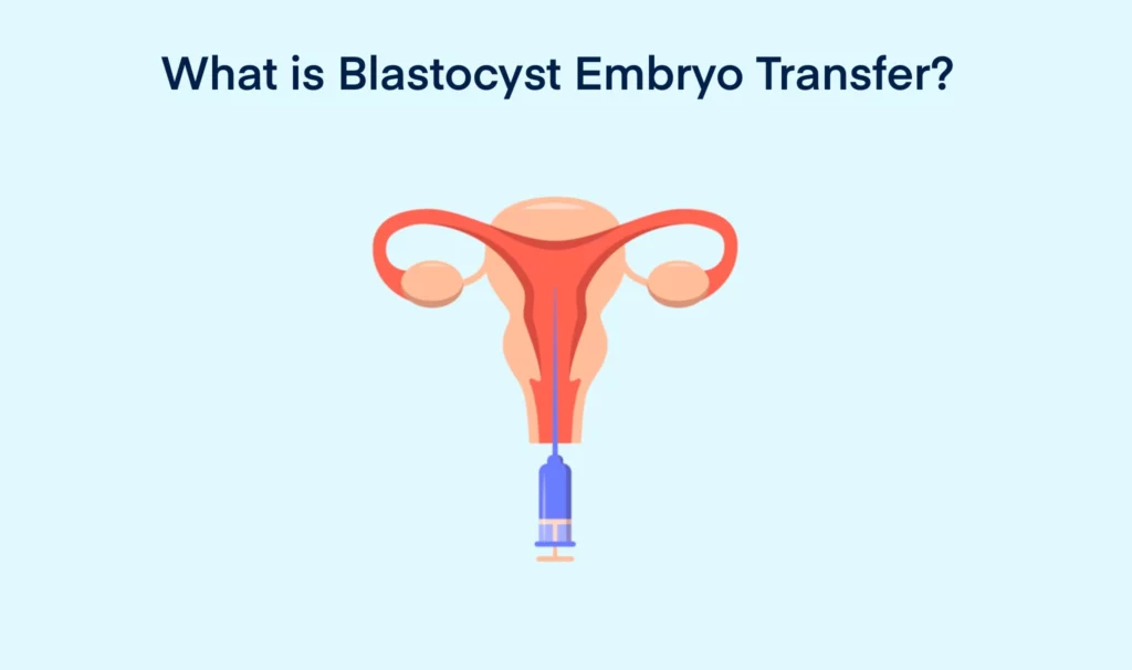 What is Blastocyst Embryo Transfer