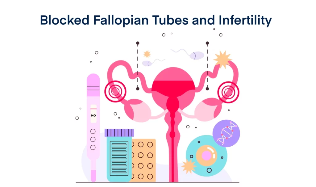 Blocked Fallopian Tubes and Infertility