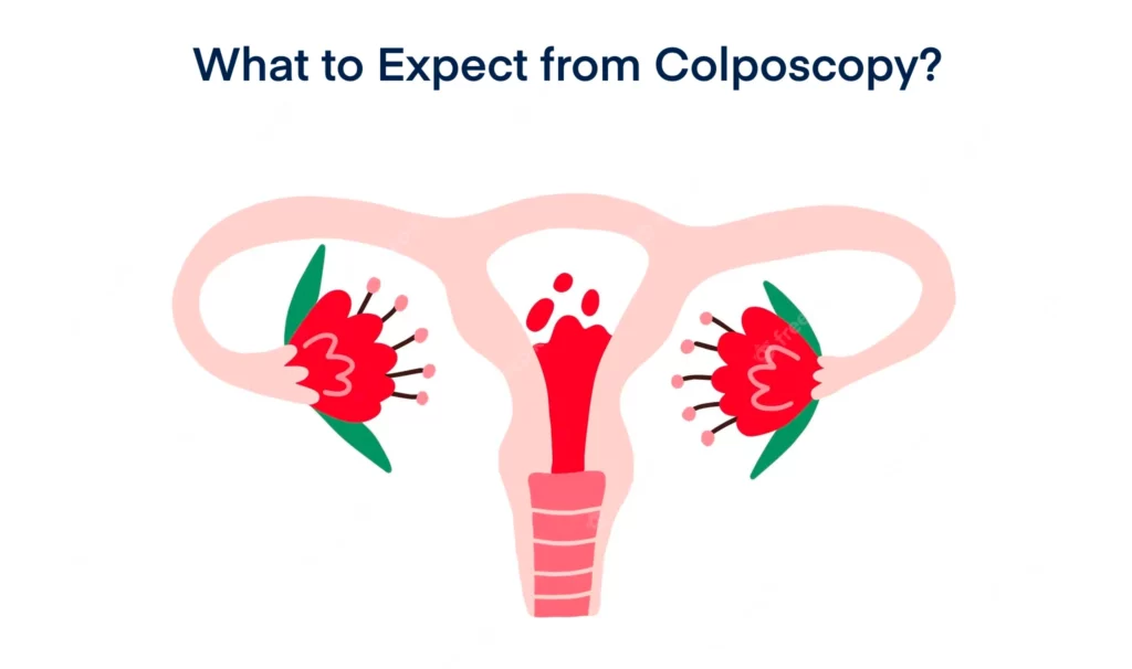 What to Expect from Colposcopy