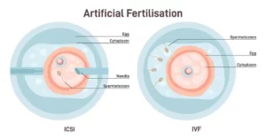 ICSI vs IVF