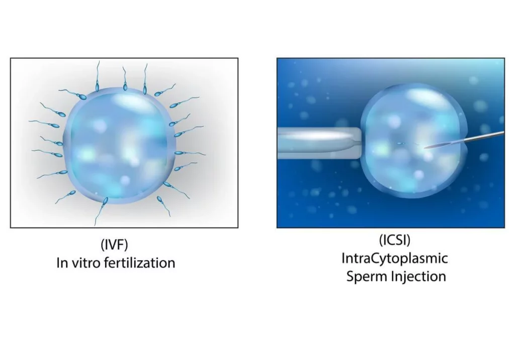 Understanding ICSI and IVF